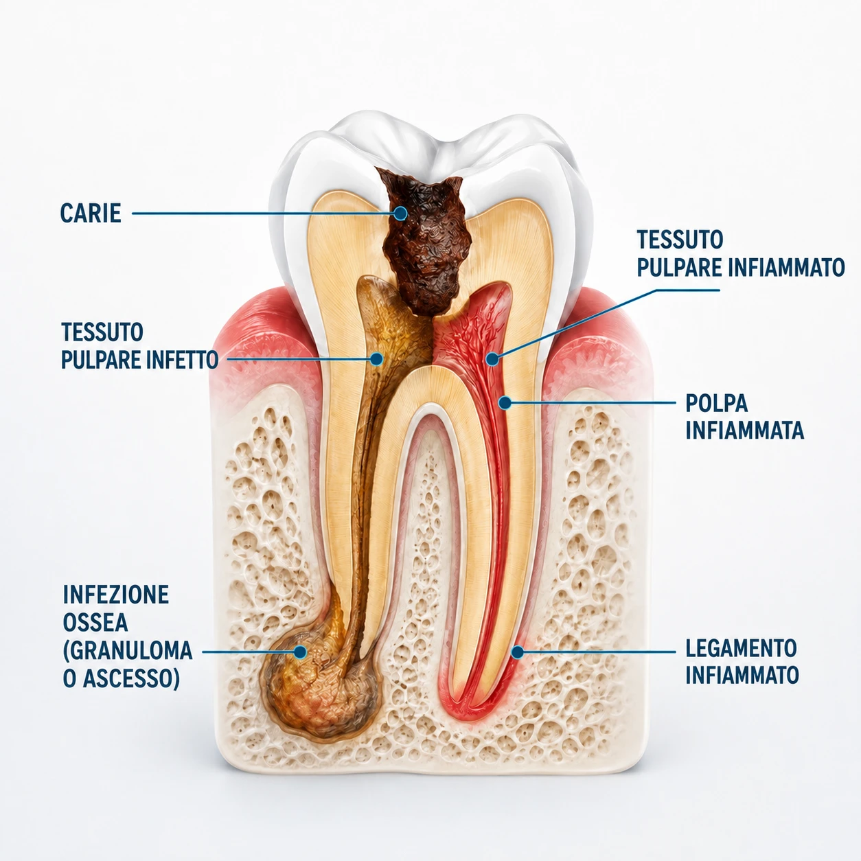 Ho devitalizzato un dente - Studio dentistico Ferlin - dentista a Legnago Devitalizzazione - Studio dentistico Ferlin - dentista a Legnago