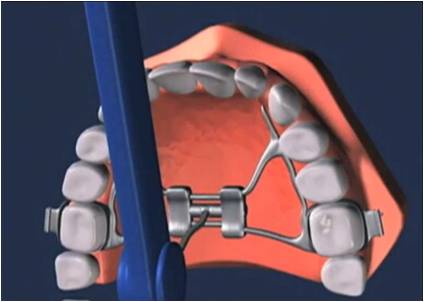 Espansore-rapido - Studio dentistico Ferlin