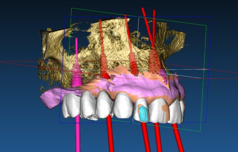 Chirurgia guidata legnago - Studio dentistico Ferlin - dentista a Legnago