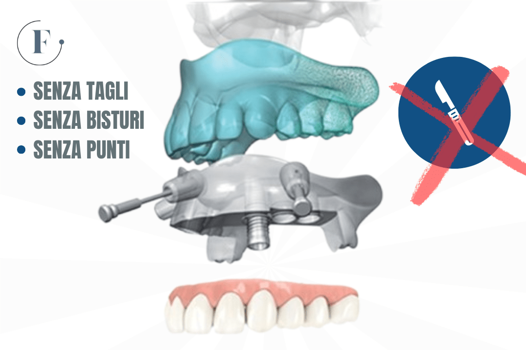 Implantologia senza bisturi