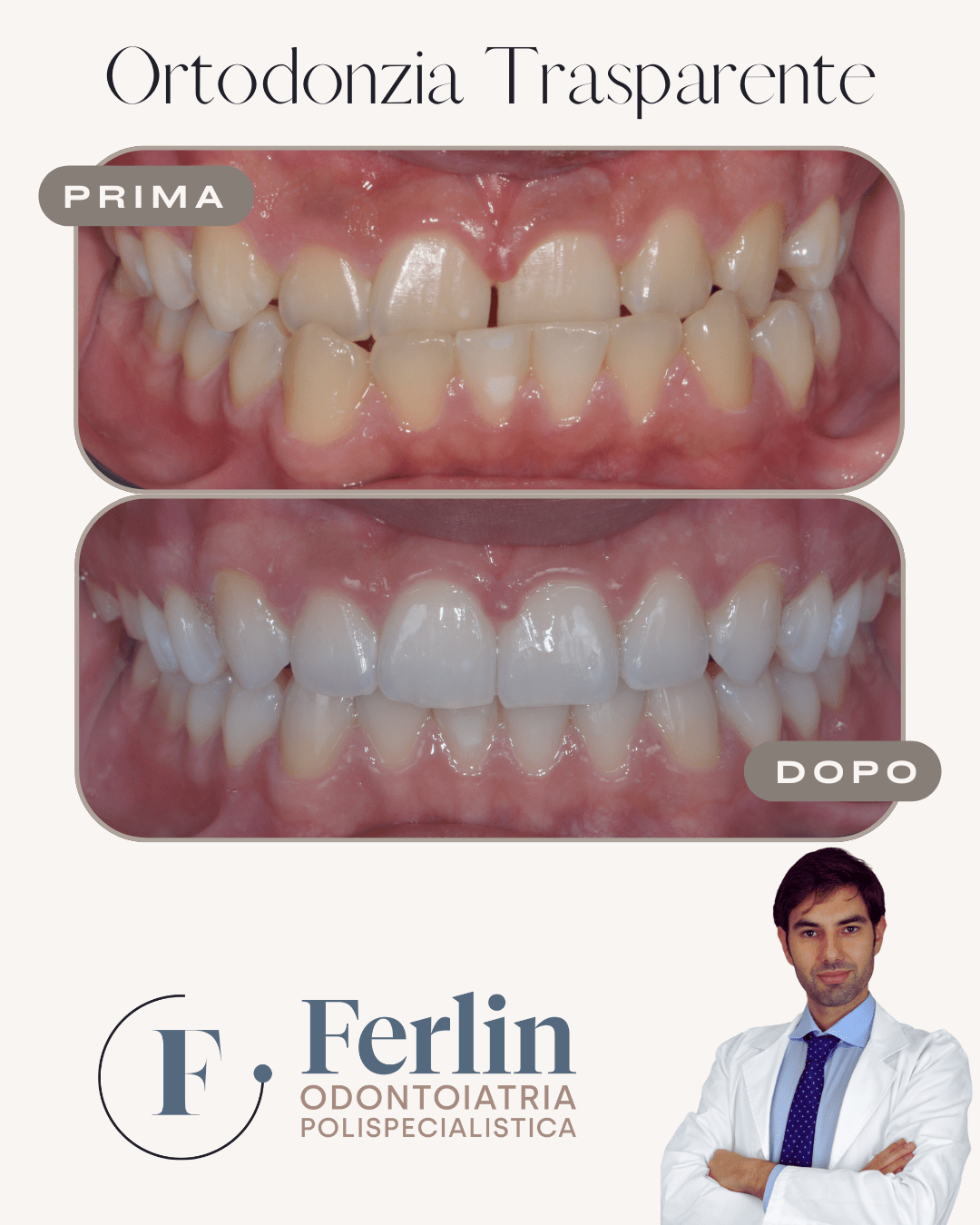 Ortodonzia trasparente legnago - Studio dentistico Ferlin - dentista a Legnago
