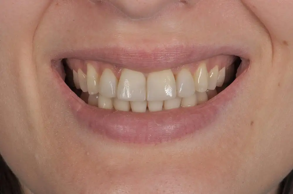 Ortodonzia invisibile: opinioni, potenzialità e vantaggi - Studio dentistico Ferlin - dentista a Legnago After image alt