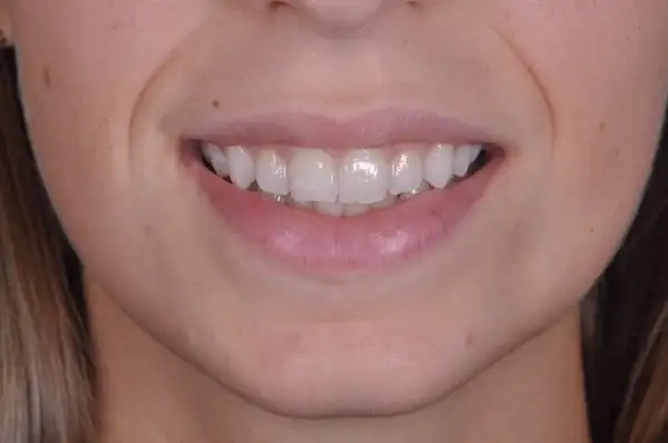 Sbiancamento Dentale a Legnago - Studio dentistico Ferlin - dentista a Legnago After image alt