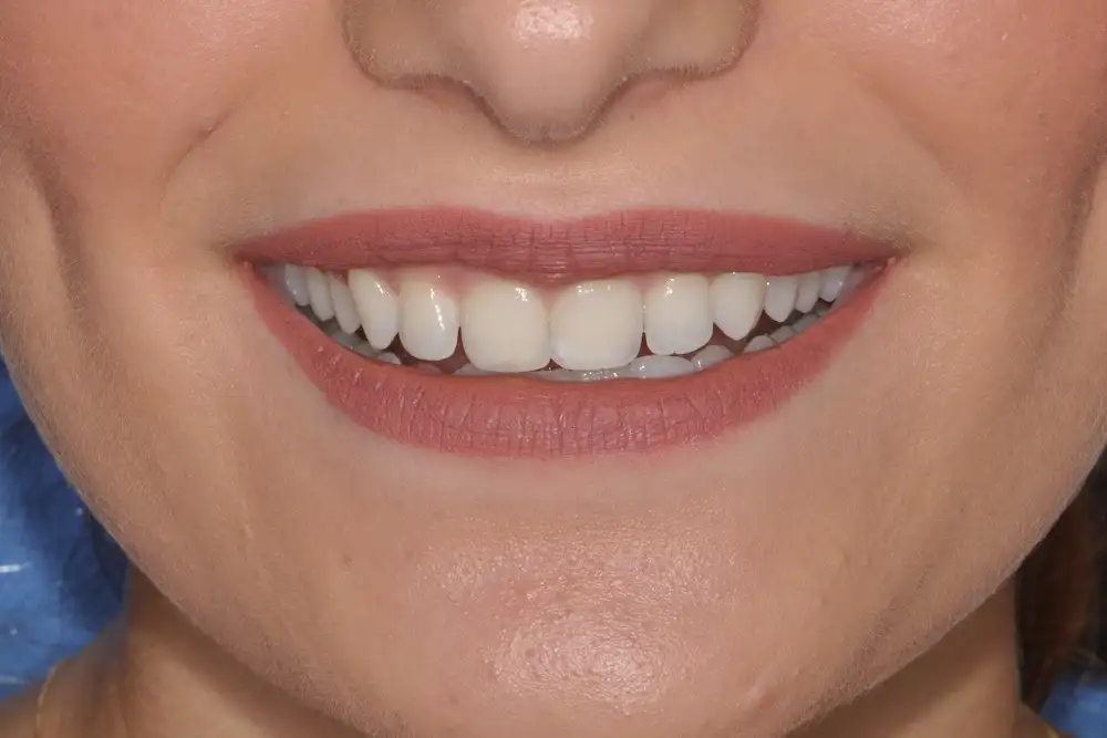 Sbiancamento Dentale a Legnago - Studio dentistico Ferlin - dentista a Legnago After image alt