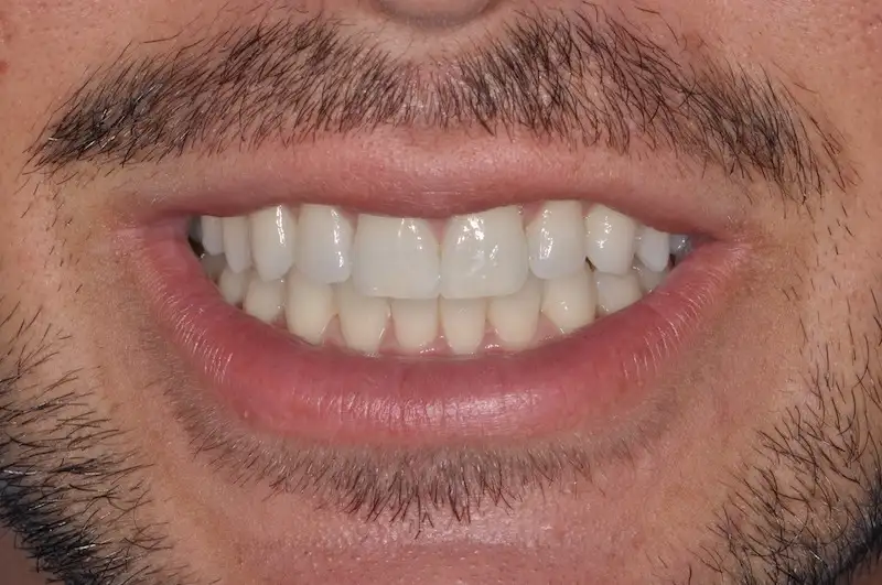 Sbiancamento Dentale a Legnago - Studio dentistico Ferlin - dentista a Legnago After image alt