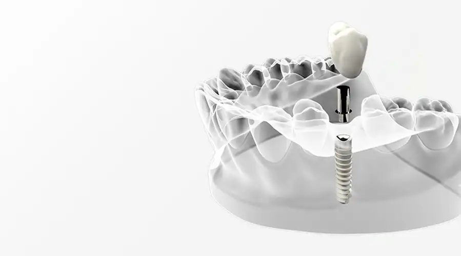 impianti dentali - Dentista a Legnago: Studio Dentistico Ferlin