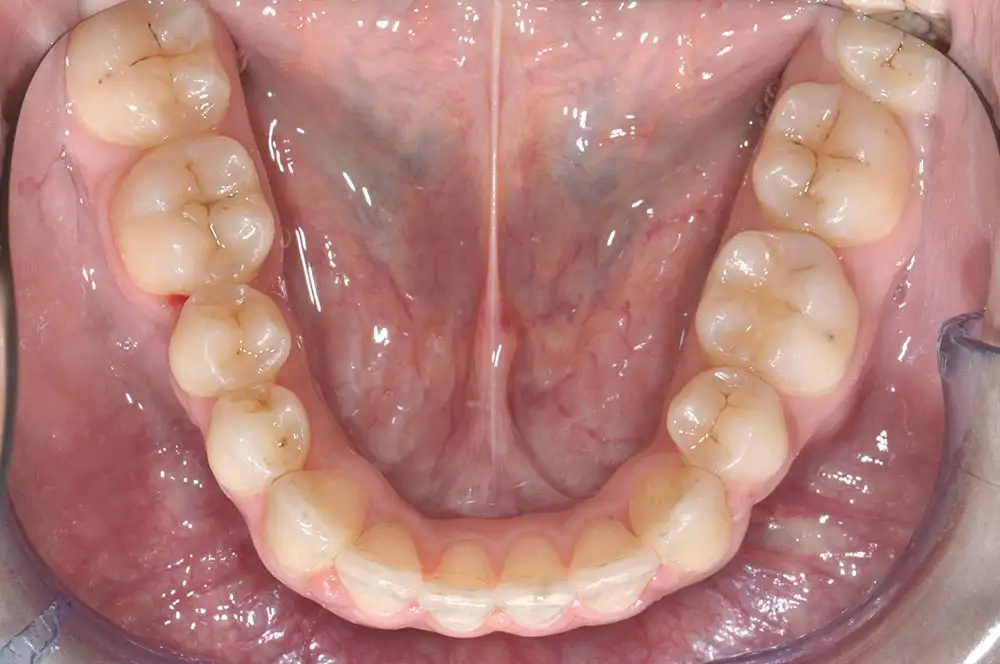 Ortodonzia invisibile: opinioni, potenzialità e vantaggi - Studio dentistico Ferlin - dentista a Legnago After image alt