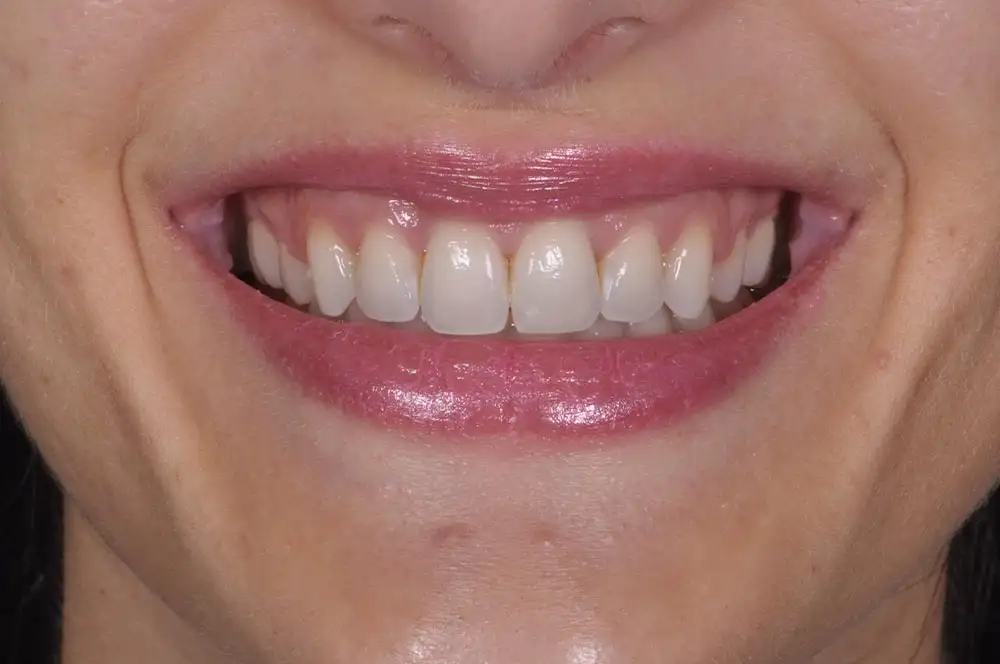 Ortodonzia invisibile: opinioni, potenzialità e vantaggi - Studio dentistico Ferlin - dentista a Legnago After image alt