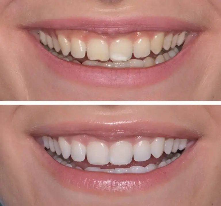 Sbiancamento Dentale a Legnago - Studio dentistico Ferlin - dentista a Legnago Sbiancamento Professionale a Legnago - Studio dentistico Ferlin