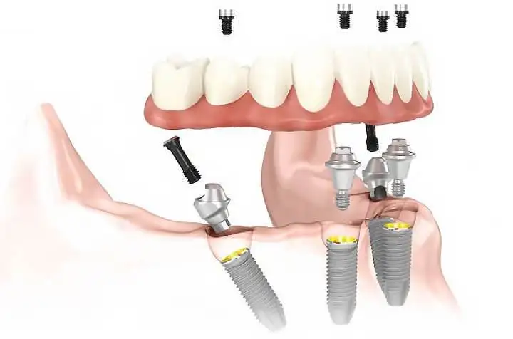 allon4 - Studio dentistico Ferlin - dentista a Legnago