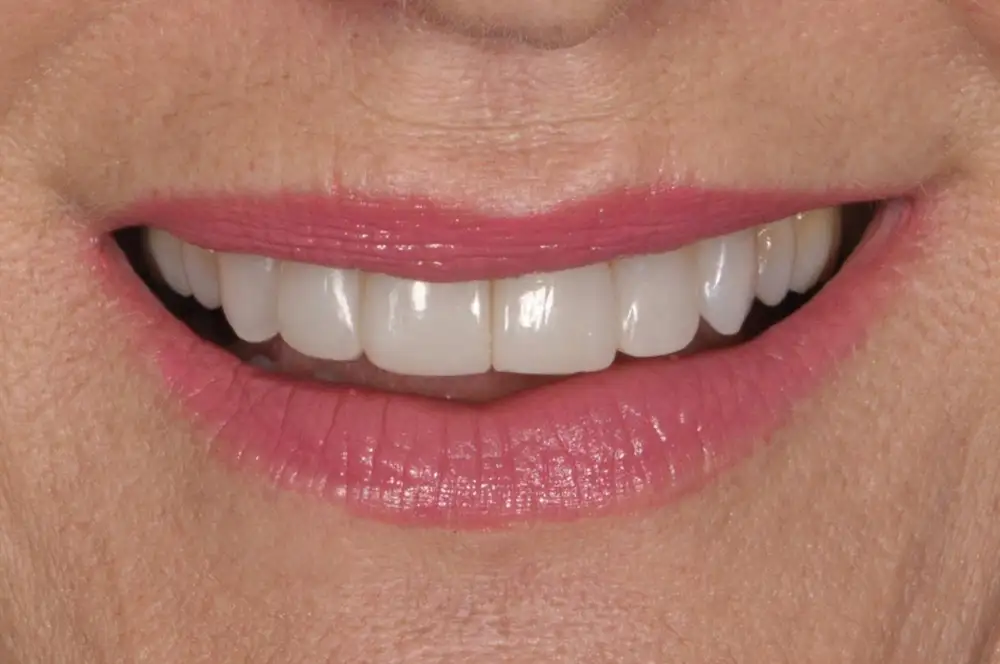 Conservativa Estetica - Studio dentistico Ferlin - dentista a Legnago After image alt