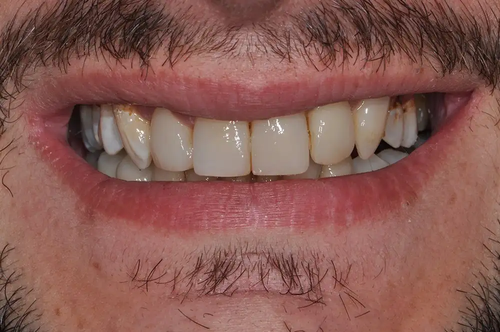 Conservativa Estetica - Studio dentistico Ferlin - dentista a Legnago After image alt