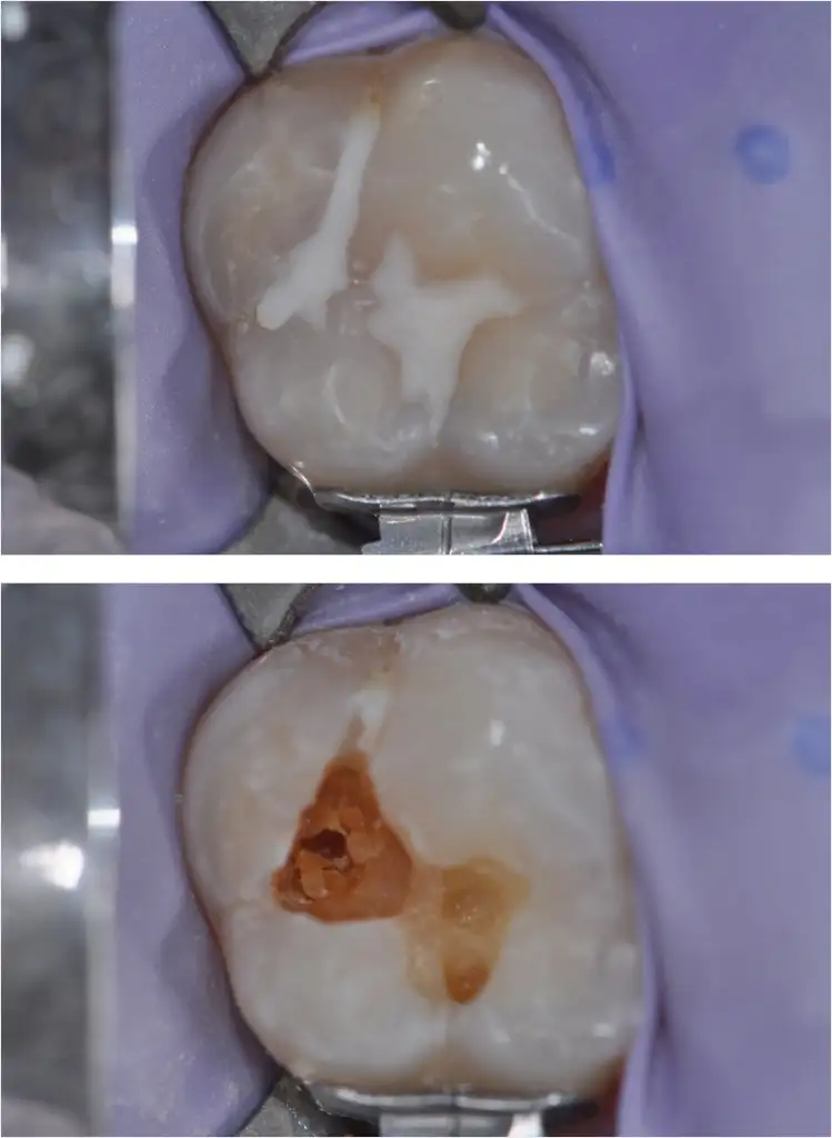 Endodonzia Specialistica: quando il dente fa male - Studio dentistico Ferlin - dentista a Legnago dente cariato - Studio dentistico Ferlin