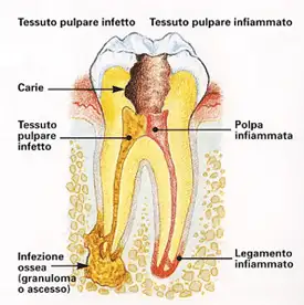 Endodonzia Specialistica: quando il dente fa male - Studio dentistico Ferlin - dentista a Legnago endodonzia specialistica - Studio dentistico Ferlin