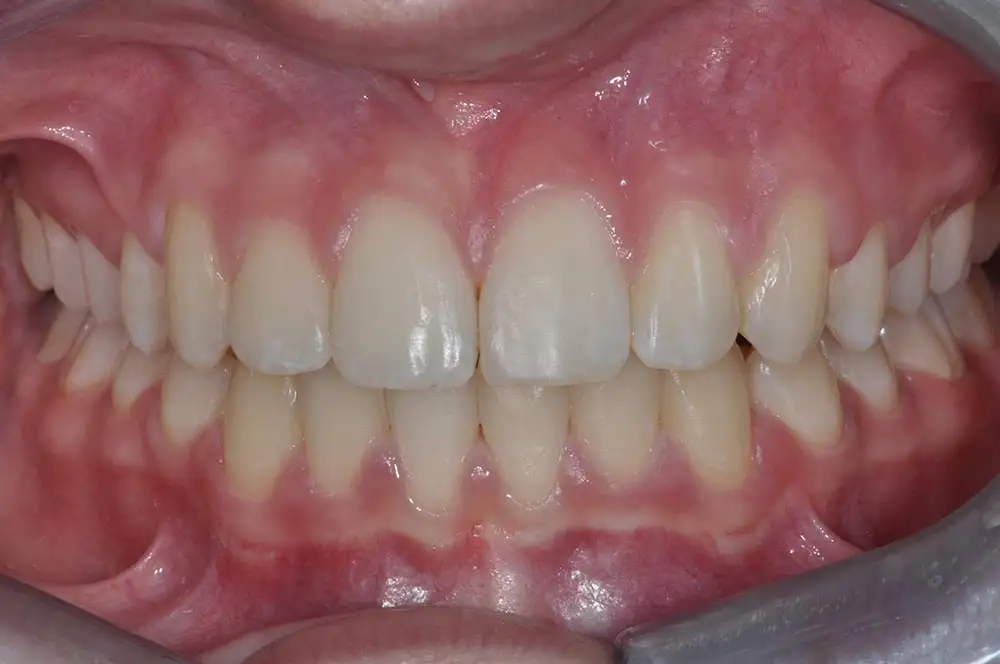 Ortodonzia invisibile: opinioni, potenzialità e vantaggi - Studio dentistico Ferlin - dentista a Legnago After image alt