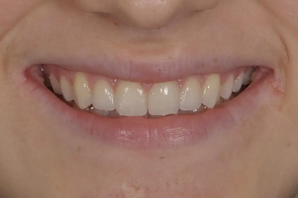 Ortodonzia invisibile: opinioni, potenzialità e vantaggi - Studio dentistico Ferlin - dentista a Legnago After image alt