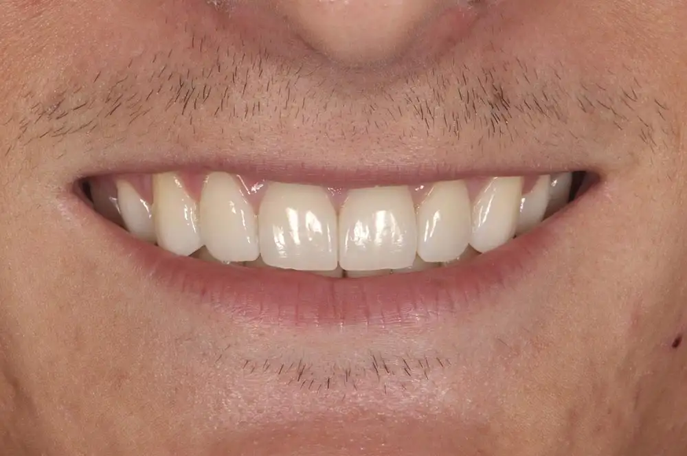 Ortodonzia invisibile: opinioni, potenzialità e vantaggi - Studio dentistico Ferlin - dentista a Legnago After image alt