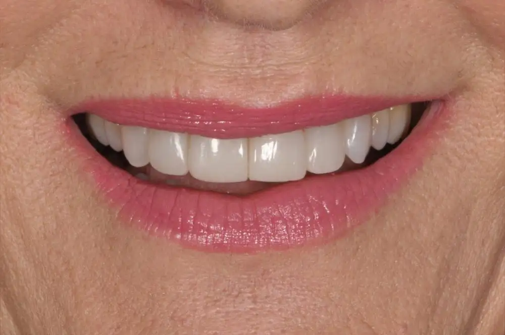 Ortodonzia invisibile: opinioni, potenzialità e vantaggi - Studio dentistico Ferlin - dentista a Legnago After image alt