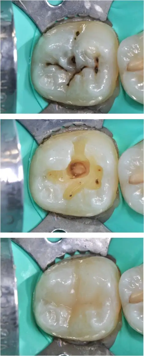 Conservativa Estetica - Studio dentistico Ferlin - dentista a Legnago otturazione conservativa - Studio dentistico Ferlin