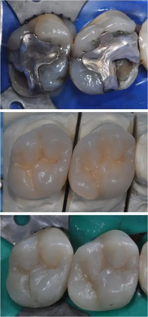 Conservativa Estetica - Studio dentistico Ferlin - dentista a Legnago otturazione conservativa - Studio dentistico Ferlin