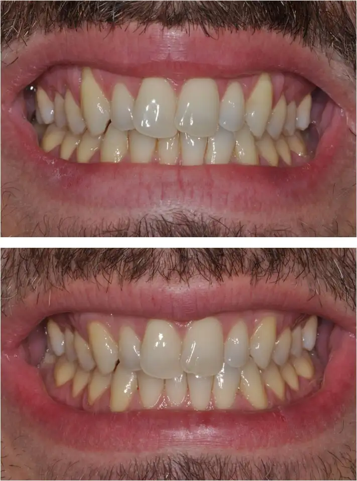 recessione dei canini - Studio dentistico Ferlin