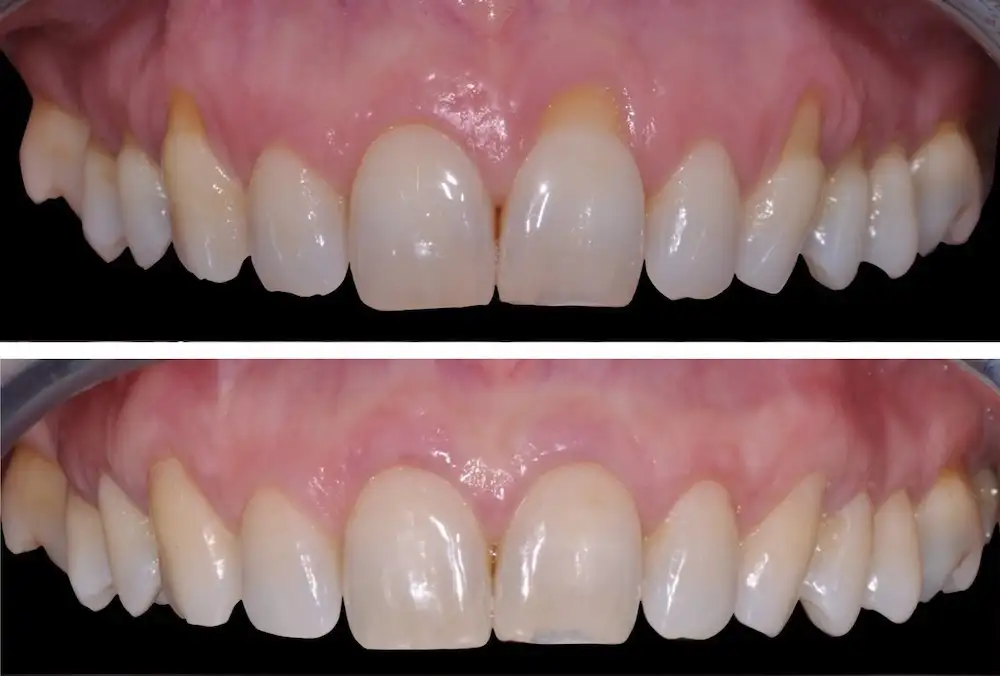 recessioni confronto - Studio dentistico Ferlin