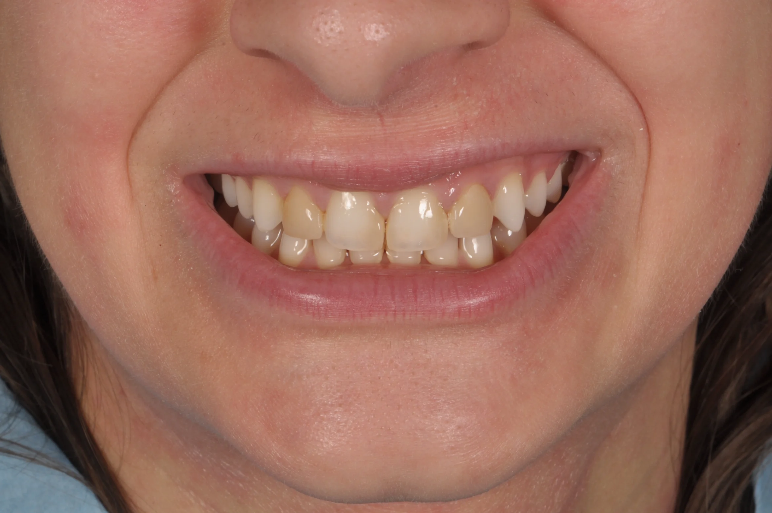 Before image alt