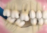 impianti dentali cerea - Studio dentistico Ferlin